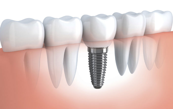 Implantodontia: Implante Dentário