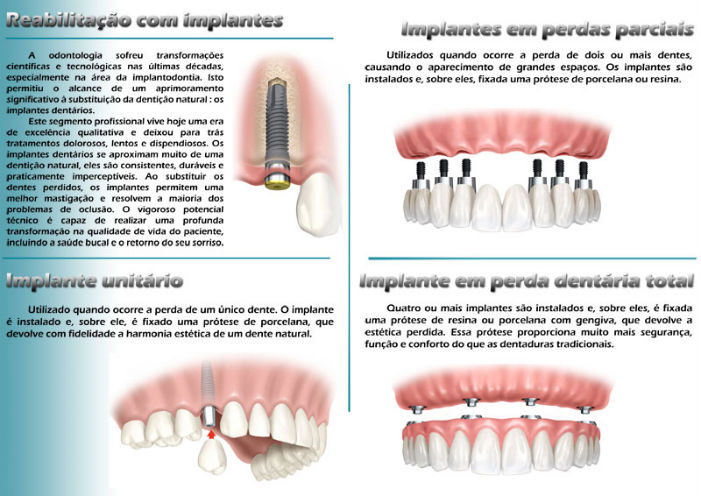 Implantodontia: Implante Dentário