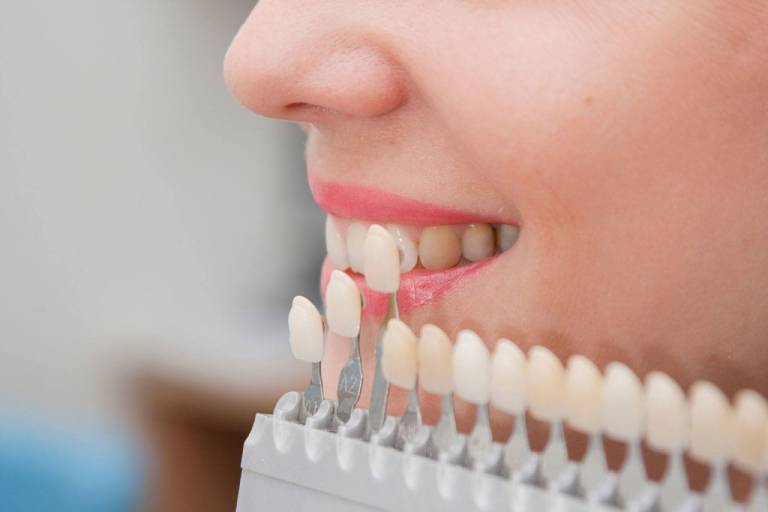 Facetas de Porcelana x Lentes de Contato Dentais: Como deixar meus dentes mais bonitos? 1 facetas de porcelana