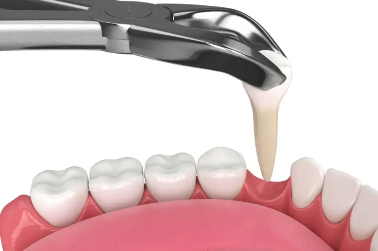 extracao-dentaria-na-odonto extracao dentaria na odonto