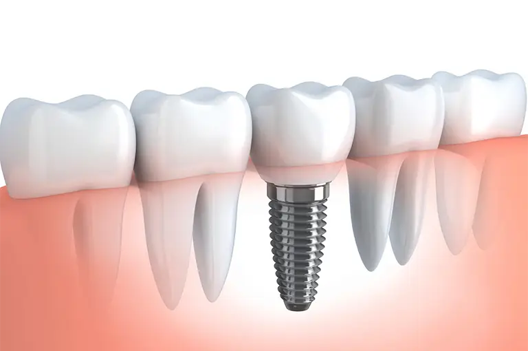implante-dentario-na-odonto implante dentario na odonto