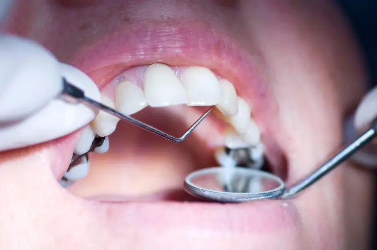 restauracao-dentaria-na-odonto restauracao dentaria na odonto