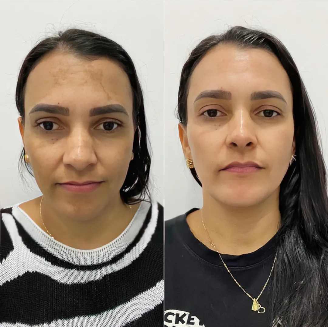 antes e depois 1